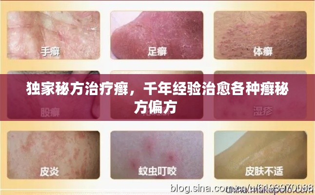 独家秘方治疗癣，千年经验治愈各种癣秘方偏方 