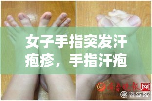 女子手指突发汗疱疹，手指汗疱疹怎么根治 