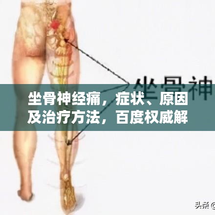 坐骨神经痛，症状、原因及治疗方法，百度权威解答！